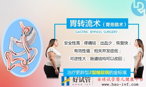 胃转流手术要满足什么条件才可以做?国内有胃转流手术吗?(图1) 胃转流手术要满足什么条件才可以做?国内有胃转流手术吗?(图1)