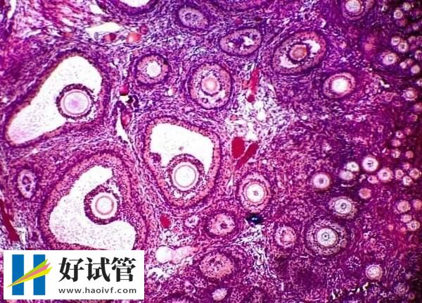 多囊卵巢做试管优势和劣势是什么(图1) 多囊卵巢做试管婴儿的优势是卵泡数量多