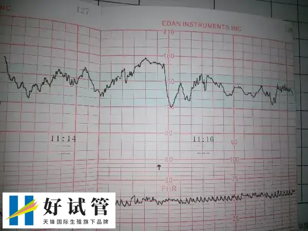 试管胚胎移植做二超能不能转产科(图2) 二超的目的是检查胎儿胎心率