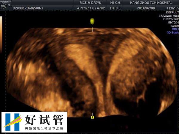 龙凤双胞胎参与性别选择